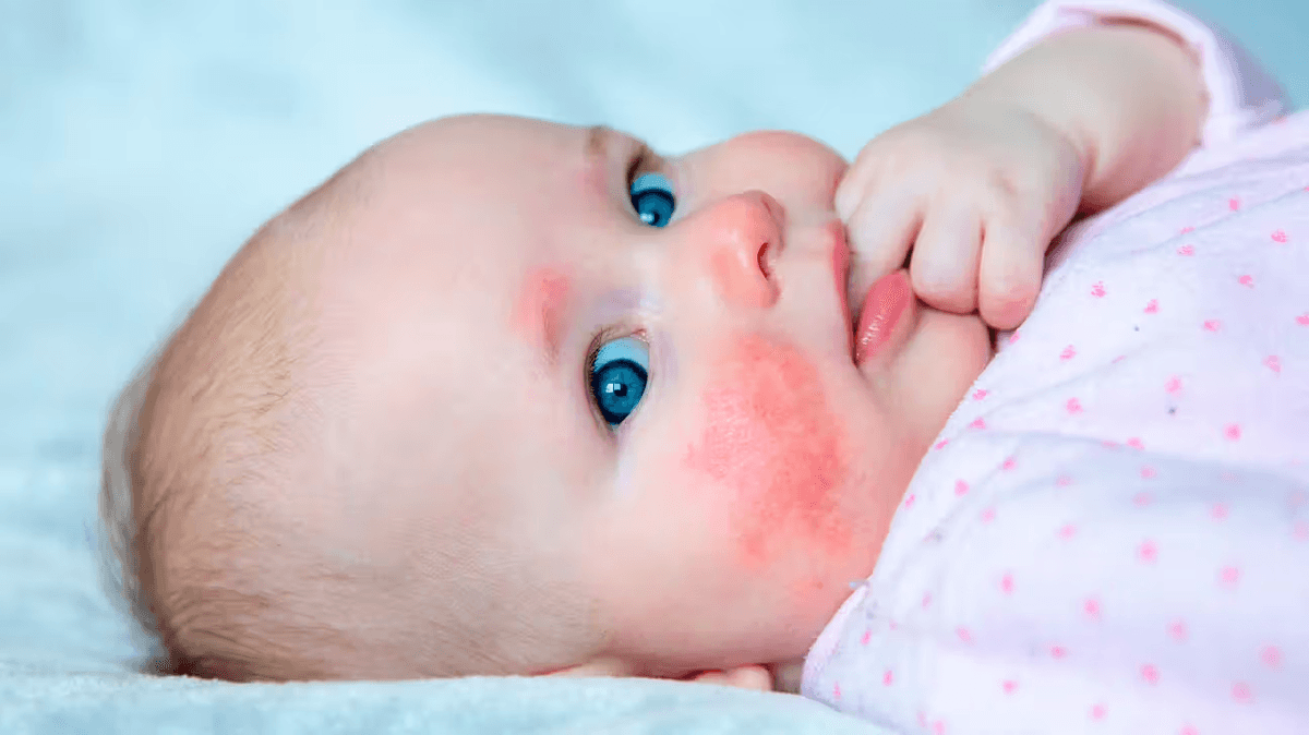 How to recognize and treat common infant&nbsp;allergies