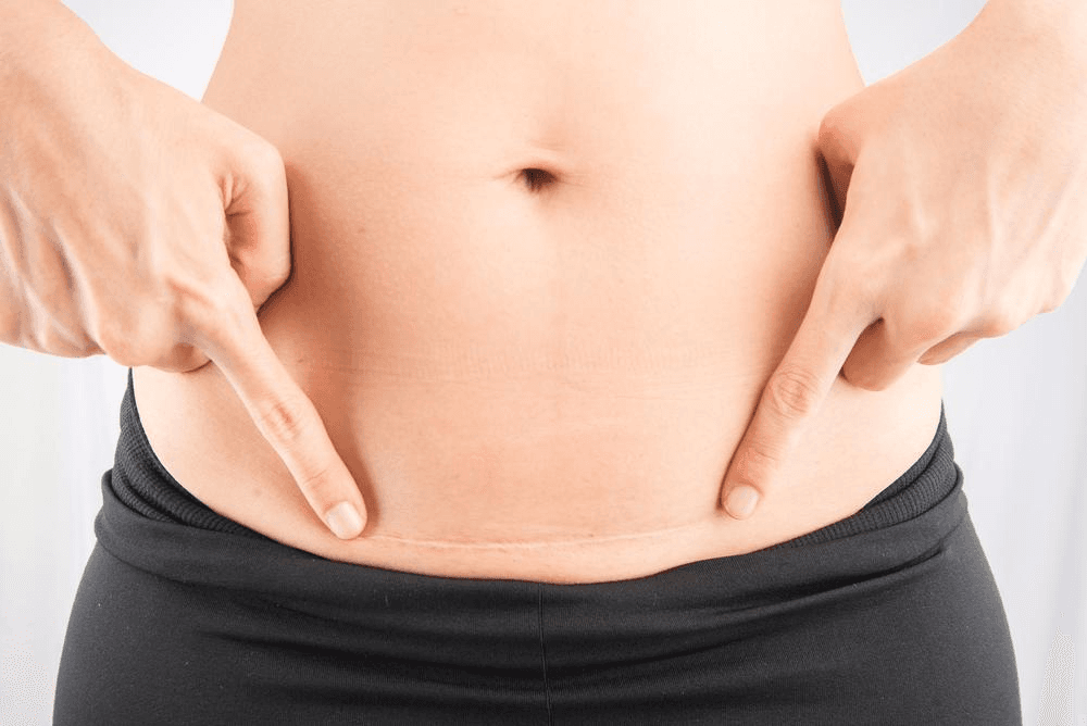 What to expect after a&nbsp;C-section