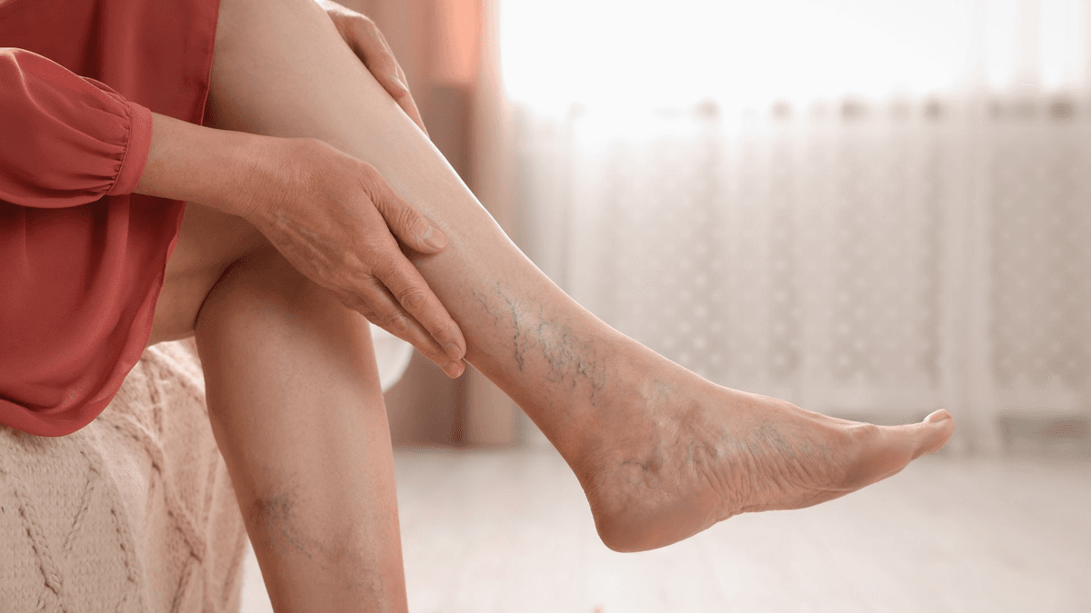 Coping with varicose&nbsp;veins