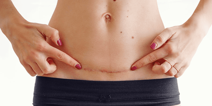 How to heal from a&nbsp;C-section
